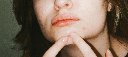 Does Castor Oil Clog Pores?
